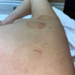 Sunrise Massage Therapy - Cupping circles OK For massage, her nails or something cut my skin and I have a big scratch that hurts (this is after 24 hours!)