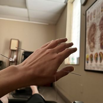 Lowry Community Acupuncture - Acupuncture - Acupuncture Near Me - Bloomington, Minnesota Lowry Community Acupuncture - Acupuncture - Acupuncture Near Me - Bloomington, Minnesota