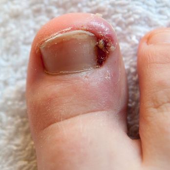Angel Nails - Hellen did this to my foot. It really hurts - Nail Salons Near Me - Sparks, Nevada Angel Nails - Hellen did this to my foot. It really hurts - Nail Salons Near Me - Sparks, Nevada