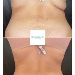 Renewlogie Med Spa - EmsculptNEO transformation at Renewlogie. Patient completed a series of 6.