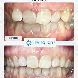 Middlesex Family Dental - Real results: Clear Invisalign aligners for a straighter, healthier smile. Call (732) 926-1234 to get started.