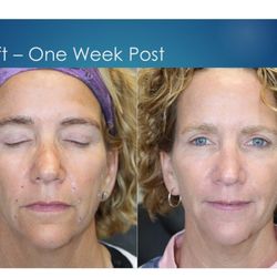 Michael Sarti, MD - Take years off of your face with Instalift.