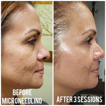 Skincare Evolution - Amazing life changing and self esteem boosting results. All this from 3 sessions of microneedling with all natural serums. - Skin Care Near Me - Coral Springs, Florida Skincare Evolution - Amazing life changing and self esteem boosting results. All this from 3 sessions of microneedling with all natural serums. - Skin Care Near Me - Coral Springs, Florida