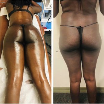 Smooth Body Contours - 2 treatment - Body Contouring Near Me - Orlando, Florida