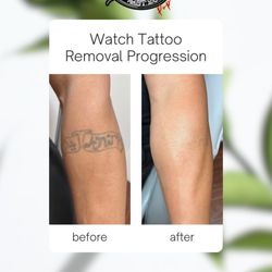 New Skin Tattoo Removal Pop-Up Clinic - Laser tattoo removal of old tattoo. 12 sessions total.