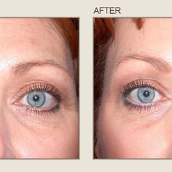 Center For Eye & Laser Surgery - Before & After
Center for Eye & Laser Surgery- Severna Park, Maryland