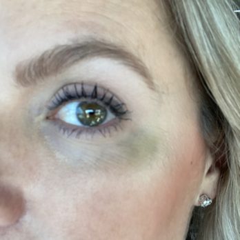 Momma's Medi Spa - Bruising after receiving Botox from BJ. (This is my attempt to cover it with makeup!) - Medical Spas Near Me - Solana Beach, California Momma's Medi Spa - Bruising after receiving Botox from BJ. (This is my attempt to cover it with makeup!) - Medical Spas Near Me - Solana Beach, California