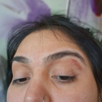 Darling Sugar - My left brow you can see the skin burned and irritated - Sugaring Near Me - Seattle, Washington Darling Sugar - My left brow you can see the skin burned and irritated - Sugaring Near Me - Seattle, Washington