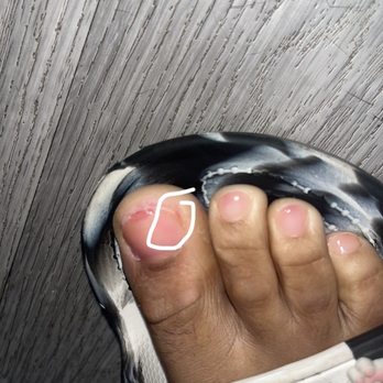 Lee's Nails & Spa - My raw toe nail now - Nail Salons Near Me - Colton, California