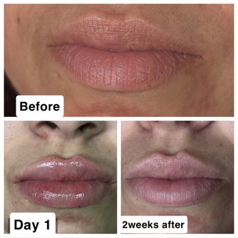 Smileyy Lash Studio - Lip fillers - Eyelash Service Near Me - Bradenton, Florida Smileyy Lash Studio - Lip fillers - Eyelash Service Near Me - Bradenton, Florida