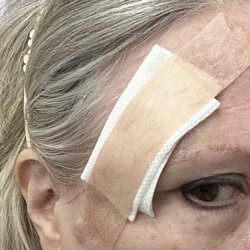 Georgia Dermatology & Skin Cancer Center - All patched up and ready to go! 1 Surgery not 2!! MOSH Specialist Dr. Emily de Golain