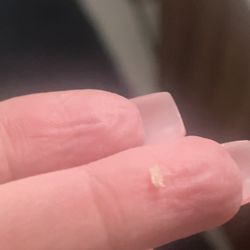 Boris Cosmetic Surgical Center and Med Spa - Stitch number #10 came out four months later