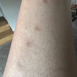Bend Dermatology Clinic - Multiple scars: all of them are atrophic, pigmented and heavily textured