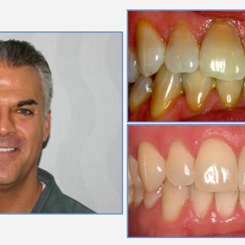Southern Dental - Rob - Veneers to correct antibiotic teeth staining! - General Dentistry Near Me - Phoenix, Arizona Southern Dental - Rob - Veneers to correct antibiotic teeth staining! - General Dentistry Near Me - Phoenix, Arizona
