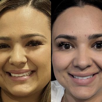 Tulua Medical - Neurotoxin Jeuveau to improve brow and eye asymmetries - Medical Spas Near Me - Gilbert, Arizona Tulua Medical - Neurotoxin Jeuveau to improve brow and eye asymmetries - Medical Spas Near Me - Gilbert, Arizona