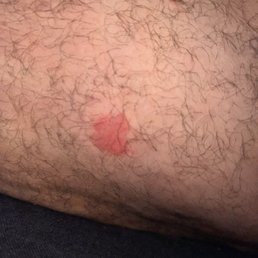 Bug bite Bug bite