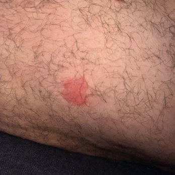 Olympus Encantada - Bug bite - Apartments Near Me - Albuquerque, New Mexico