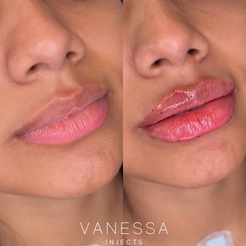 Vanessa Injects - Medical Spas Near Me - Houston, Texas Vanessa Injects - Medical Spas Near Me - Houston, Texas
