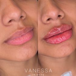 Vanessa Injects