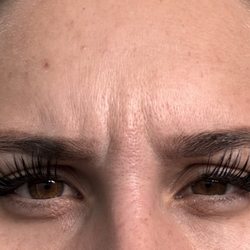 After receiving botox in my forehead and crows feet, there is ZERO improvement.