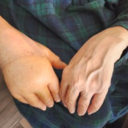 Guess which wrist broke! Now both hands look/work the same