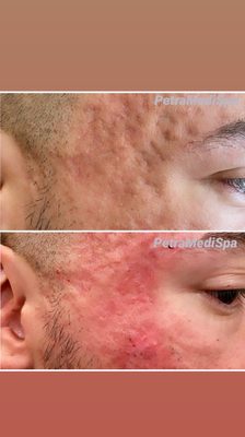 Acne Scar Removal - Fractional CO2 Laser - RENEWED COMPLEXION
Revitalizes skin by reducing signs of aging, acne scars, and sun damage, revealing a smoother and more youthful appearance.
PRECISION REJUVENATION
Targets specific skin areas with precision, promoting rapid healing and collagen production for firmer skin.
LONG-TERM BEAUTY BENEFITS
Fractional CO2 Laser treatment offers significant and lasting improvements in skin texture and tone, enhancing overall skin health and vitality. Acne Scar Removal - Fractional CO2 Laser - RENEWED COMPLEXION
Revitalizes skin by reducing signs of aging, acne scars, and sun damage, revealing a smoother and more youthful appearance.
PRECISION REJUVENATION
Targets specific skin areas with precision, promoting rapid healing and collagen production for firmer skin.
LONG-TERM BEAUTY BENEFITS
Fractional CO2 Laser treatment offers significant and lasting improvements in skin texture and tone, enhancing overall skin health and vitality.