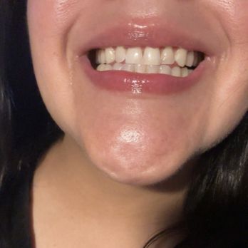 Tooth Fairy Waifu - Tonight's teeth after 1 hour whitening session - Teeth Whitening Near Me - Burbank , California Tooth Fairy Waifu - Tonight's teeth after 1 hour whitening session - Teeth Whitening Near Me - Burbank , California