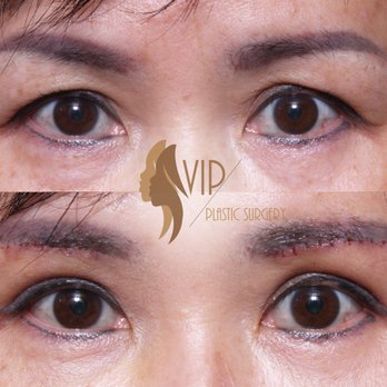 VIP Plastic Surgery - Under Eyebrow Lift by VIP Plastic Surgery - Dr. Andrew K. Choi - Cosmetic Surgeons Near Me - Los Angeles, California