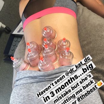 Thrive Elite Wellness Services - Cupping is amazing! - Chiropractors Near Me Thrive Elite Wellness Services - Cupping is amazing! - Chiropractors Near Me