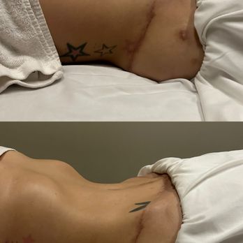 Untie and Unwind - Brazilian lymphatic massage before and after photos - Massage Therapy Near Me - Scottsdale, Arizona Untie and Unwind - Brazilian lymphatic massage before and after photos - Massage Therapy Near Me - Scottsdale, Arizona