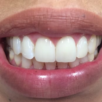 Parviz Kohanoff, DDS - After placement of two veneers on the two front teeth, #8 & #9 - General Dentistry Near Me - San Fernando, California