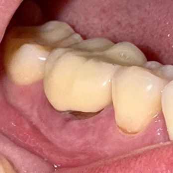 Alla Rapoport, DDS - Crown has a wrong shape and there's a gap between it and a gum. - General Dentistry Near Me - Reseda, California Alla Rapoport, DDS - Crown has a wrong shape and there's a gap between it and a gum. - General Dentistry Near Me - Reseda, California