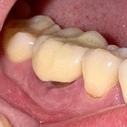 Alla Rapoport, DDS - Crown has a wrong shape and there's a gap between it and a gum.