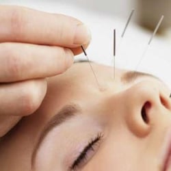Natural Health - Acupuncture