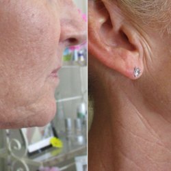 Sculpt that jawline, illuminate skin, even treat old scars.