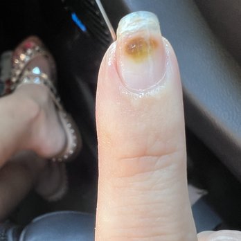ST Nail Spa - Fungus that has do be treated with prescription. - Nail Salons Near Me - Clarksville, Tennessee