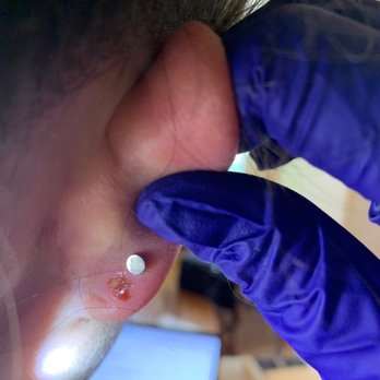 Piercing Vegas - More of the earring showing skin totally grown over it - Piercing Near Me - Las Vegas, Nevada