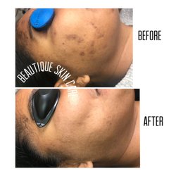 Beautique Skin Care And Body Studio - Hyperpigmentation treatment