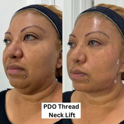 Glam MediSpa - PDO Thread Neck Lift