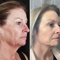 Elan Medspa - Mint PDO THREAD facelift