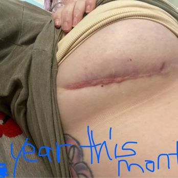 Dr Stile - Scar 1 year later - Cosmetic Surgeons Near Me - Las Vegas, Nevada Dr Stile - Scar 1 year later - Cosmetic Surgeons Near Me - Las Vegas, Nevada