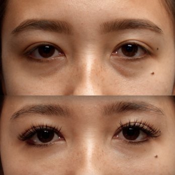 In Focus Ophthalmic Plastic Surgery - Before and After Eyelid Tear Trough Filler - No Surgery - Plastic Surgeons Near Me - Murrieta, California In Focus Ophthalmic Plastic Surgery - Before and After Eyelid Tear Trough Filler - No Surgery - Plastic Surgeons Near Me - Murrieta, California