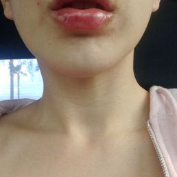 Right after treatment (Half a syringe) Right after treatment (Half a syringe)