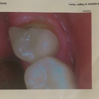 Perris Modern Dentistry - Broken crown. - General Dentistry Near Me - Perris, California
