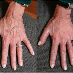 Ringpfeil Advanced Dermatology - Hand Rejuvenation with Fillers Before and After