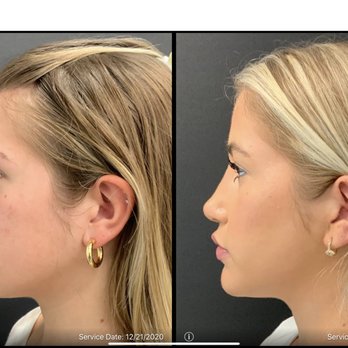 Bitar Cosmetic Surgery Institute - only 8 months post-op. I am extremely thrilled with my results so far. Dr. Bitar gave me exactly what I asked for. - Cosmetic Surgeons Near Me - Fairfax, Virginia Bitar Cosmetic Surgery Institute - only 8 months post-op. I am extremely thrilled with my results so far. Dr. Bitar gave me exactly what I asked for. - Cosmetic Surgeons Near Me - Fairfax, Virginia