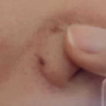 Anita B Spa - The scarring on my nose - you can see the purple spots. - Skin Care Near Me - San Francisco, California Anita B Spa - The scarring on my nose - you can see the purple spots. - Skin Care Near Me - San Francisco, California