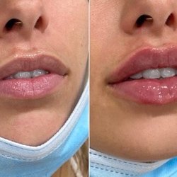 The Look Med Spa - We love lips and only do the best work. Lip filler