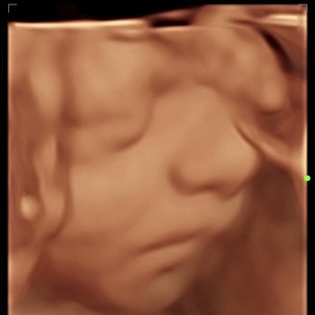 Love At First Sound - Elective, mobile, In home 3D 4D HD ultrasound, early gender determination - Ultrasound Imaging Centers Near Me