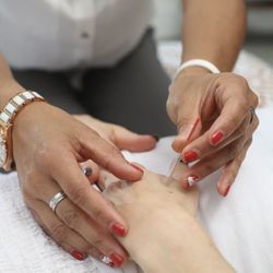 Northwest Community Acupuncture - Acupuncture